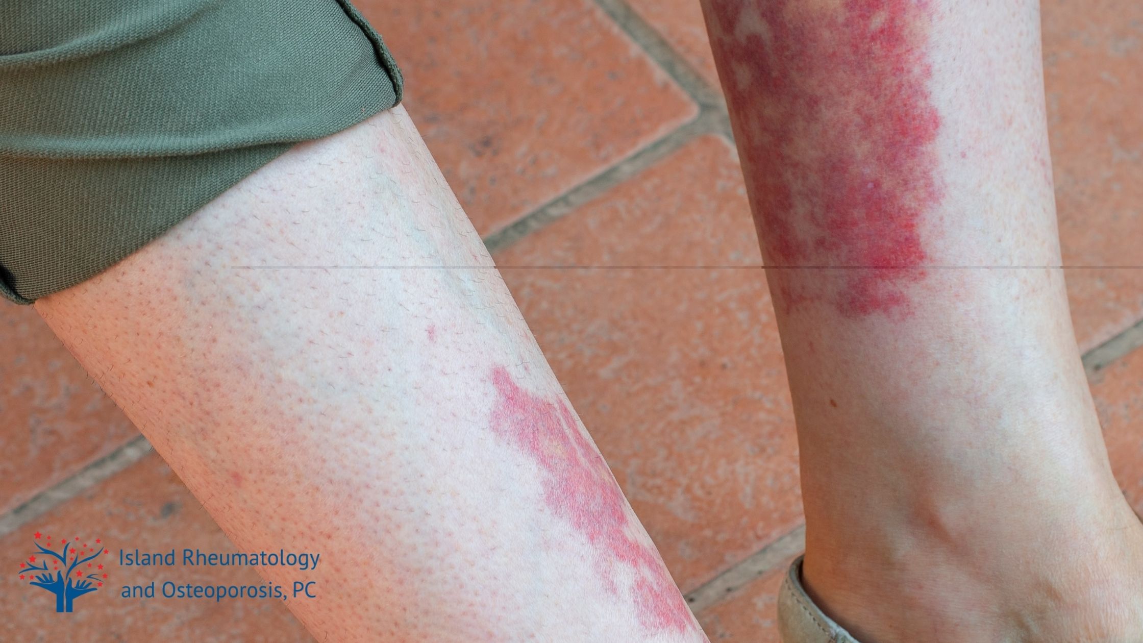 Two lower legs with visible red, blotchy rashes on the skin, photographed against a tiled floor; logo of Island Rheumatology and Osteoporosis, PC is visible in the corner.