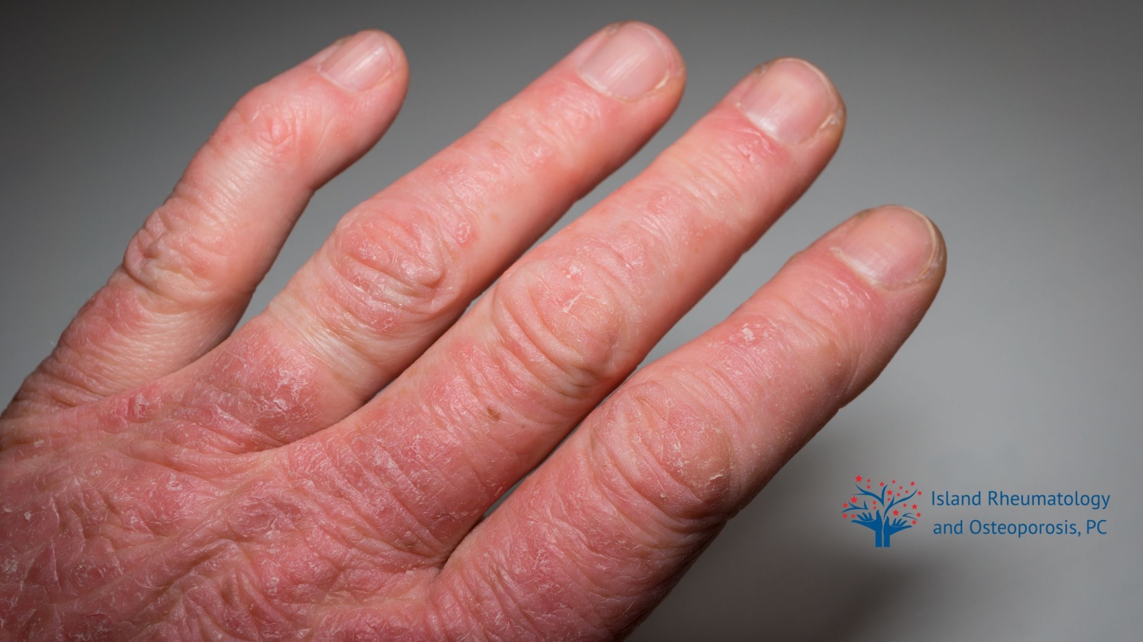 A close-up of a hand with dry, scaly, and red skin, showing symptoms of a dermatological condition. Island Rheumatology and Osteoporosis, PC logo is visible.
